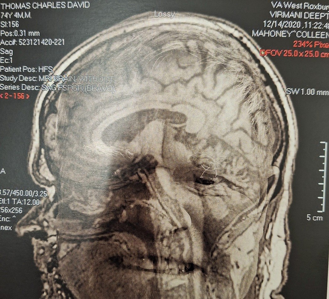 After seeing X-ray films of his brain, he created visual images of the battle with the disease. Photo: Duy Ninh Nguyen After seeing X-ray films of his brain, he created visual images of the battle with the disease. Photo: Duy Ninh Nguyen