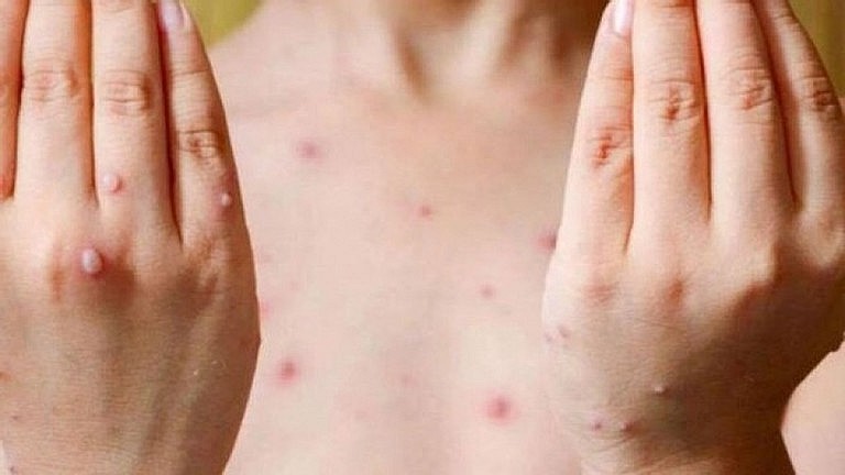 The Ministry of Health has warned about a possibly wider monkeypox outbreak during the winter-spring period. Illustrative photo. The Ministry of Health has warned about a possibly wider monkeypox outbreak during the winter-spring period. Illustrative photo.